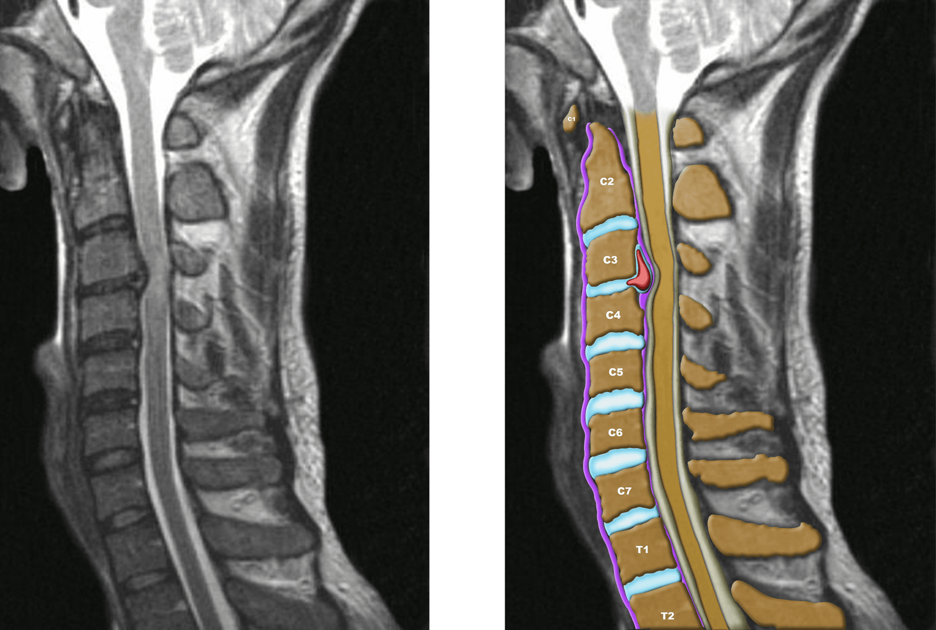 Make your spine MRIs come to life with our artist's colorization.