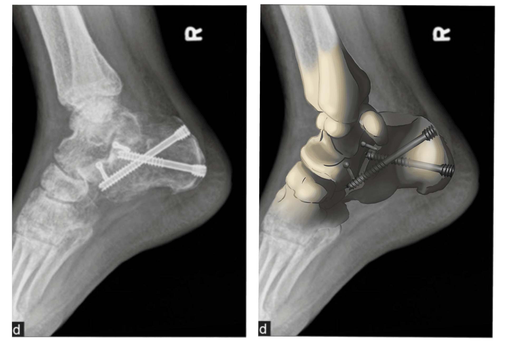 Open Reduction and Internal Fixation
